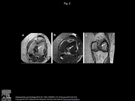 Association of mucoid degeneration of anterior cruciate ligament with knee meniscal and ...