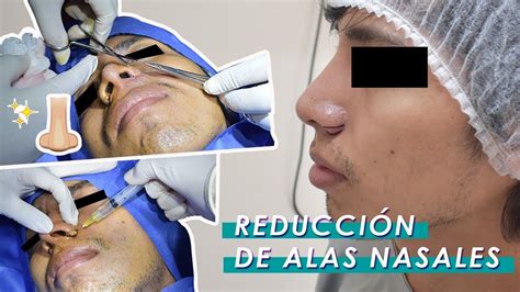 Reducción de Alas Nasales (Nariz grande) - Dr Cesar Calderon Cirujano Plastico - Trujillo Peru ...