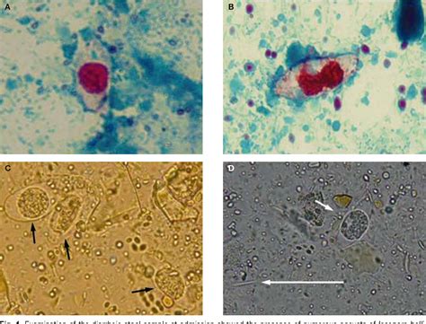 Severe diarrhea due to Isospora belli in a patient with thymoma ...