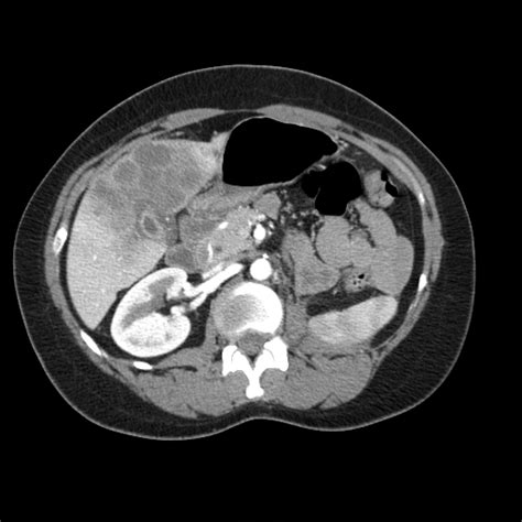 Gallbladder cancer CT - wikidoc