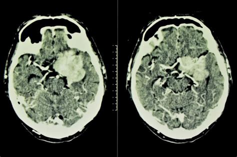 What Does A Brain Tumor Look Like On A Ct Scan Ct Scan Machine | Images and Photos finder