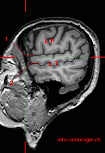 Lateral Sulcus - W-Radiology