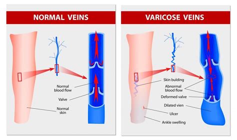 Venous Insufficiency Pictures Symptoms Causes Treatme - vrogue.co