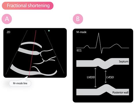 Fractional shortening for estimation of ejection fraction – Cardiovascular Education