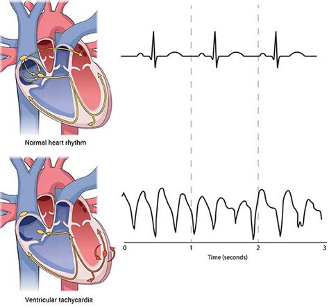 Ventricular fibrillation causes, symptoms, diagnosis, treatment & prognosis