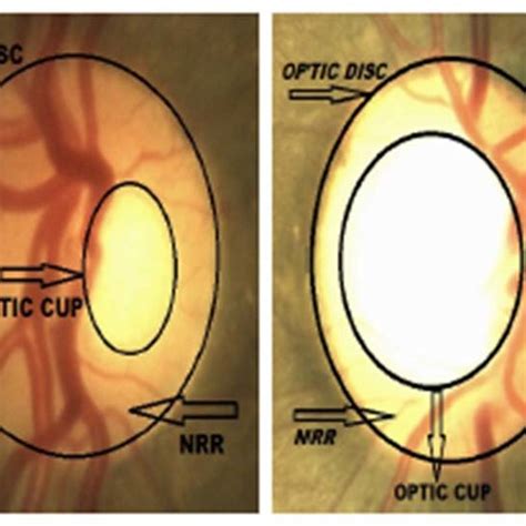 (PDF) Assessment of the Cup-to-Disc ratio method for Glaucoma detection