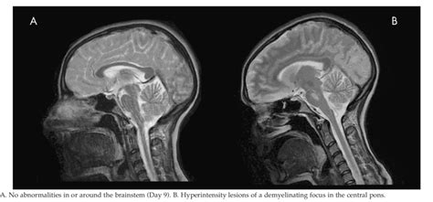 MRI Scans of a Young Woman with Anorexia Nervosa | Download Scientific ...