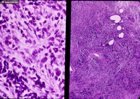 Histology: Rhabdomyosarcoma, Embryonal Type - NYEE