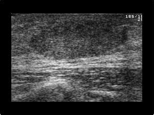 Breast and Axilla | 5.8 Male breast : Case 5.8.1 Gynaecomastia | Ultrasound Cases