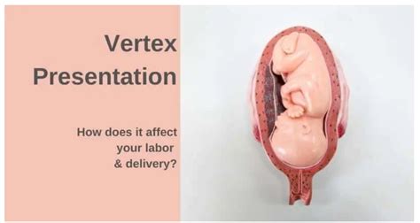 Understanding Vertex Presentation: Your Baby’s Ideal Position for Birth ...