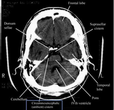 How to read a head CT - Emergency Medicine Education | NewYork ...