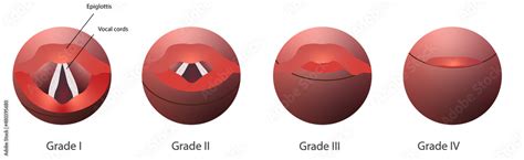 Cormack-Lehane system to assess the airway dificulty in intubation. Grade system to classifies ...