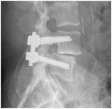 Posterior Lumbar Spinal Fusion