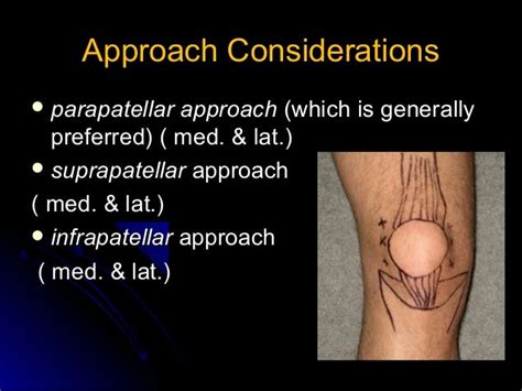 Knee arthrocentesis