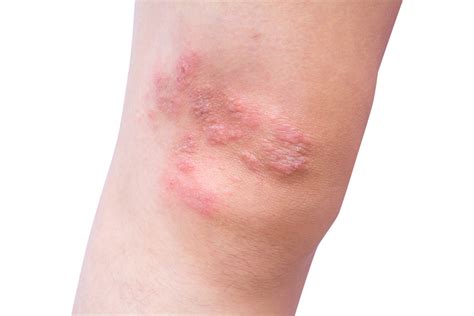 What Causes Dermatitis Herpetiformis? - Redorbit