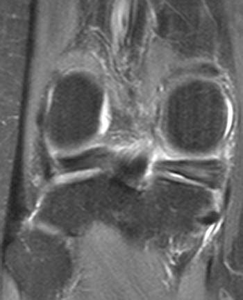 Posterior Root Tear of the Medial Meniscus | Radsource