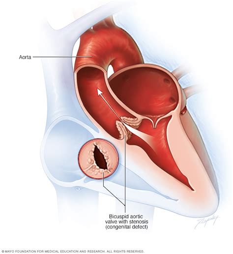 Bicuspid Aortic Valve Repair