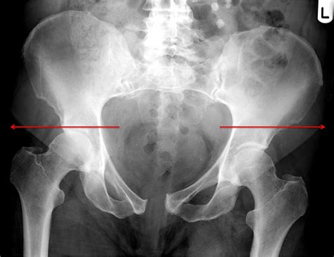 Pelvic Fracture X Ray