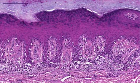 Focal invasiveness in complete histological analyses of a large acral lentiginous melanoma ...