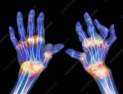 Rheumatoid arthritis of the hands, X-ray - Stock Image - C039/1639 - Science Photo Library