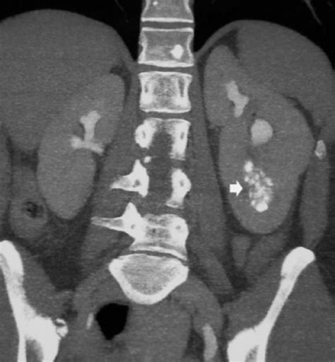 Medullary Sponge Kidney - Genitourinary Disorders - MSD Manual Professional Edition