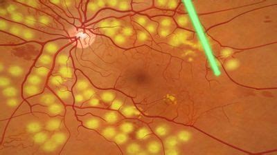 Panretinal Photocoagulation - Mohawk Valley Retina