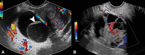 Classifying lesions on ultrasound helps predict ovarian cancer