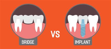 Dental Bridge Vs Implant | Monroe Family Dentistry