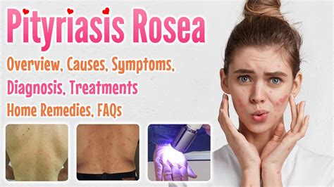 Pityriasis rosea overview, causes, sign and symptoms, diagnosis, treatment, home remedies and ...