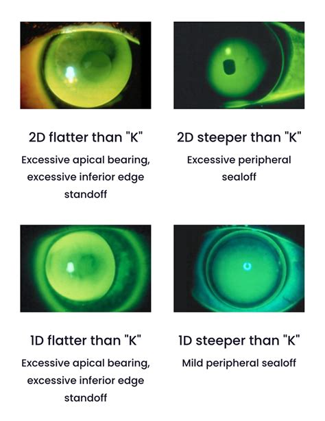 Spherical GP Lens Tools and Resources - GPLI