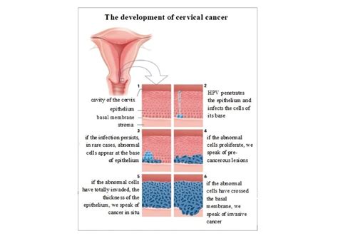 Cervical Cancer | Symptoms, Stages, Types, Diagnoses, Treatments