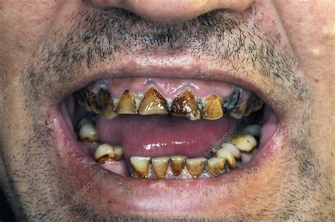 Nicotine stained and decayed teeth - Stock Image - C016/6970 - Science Photo Library