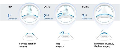 Best Lasik Surgeons In The World