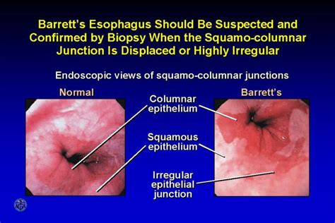 PPT - Esophagus: Normal Lower Esophageal and Squamo-columnar Junction Mucosae PowerPoint ...