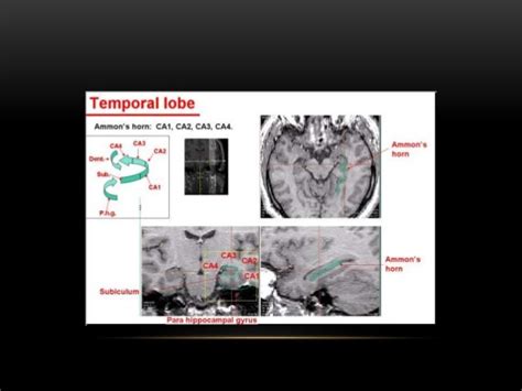 Mesial temporal lobe epilepsy