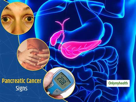 Symptoms Of Pancreatic Cancer