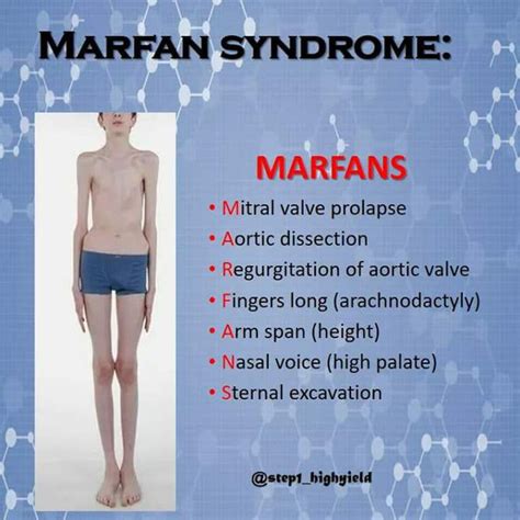 Marfan syndrome featurea - MEDizzy