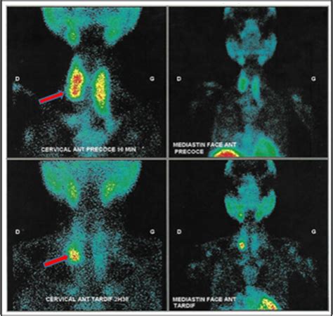 -MIBI scan showing a projecting focus at the base of the right thyroid... | Download Scientific ...