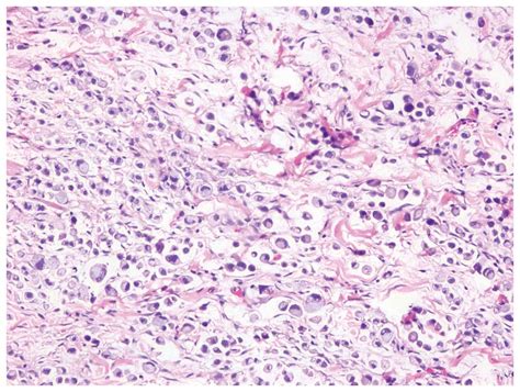 Signet-ring cell carcinoma of the colon: A case report of a 9-year-old boy