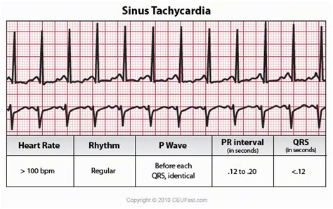 Fajarv: Short P R Interval Causes