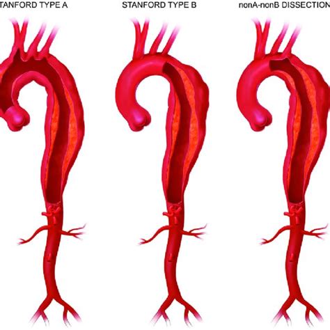 (PDF) Current Options and Recommendations for the Treatment of Thoracic Aortic Pathologies ...