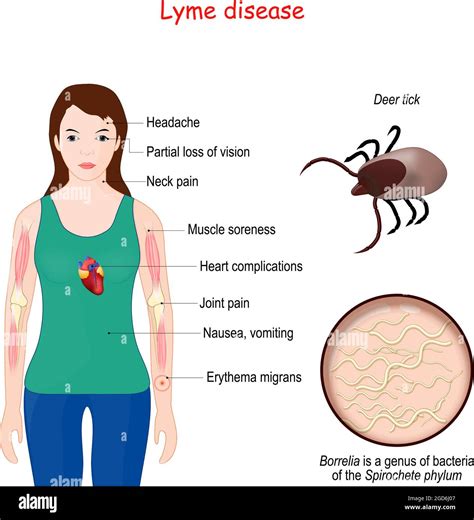 Spirochetes Symptoms