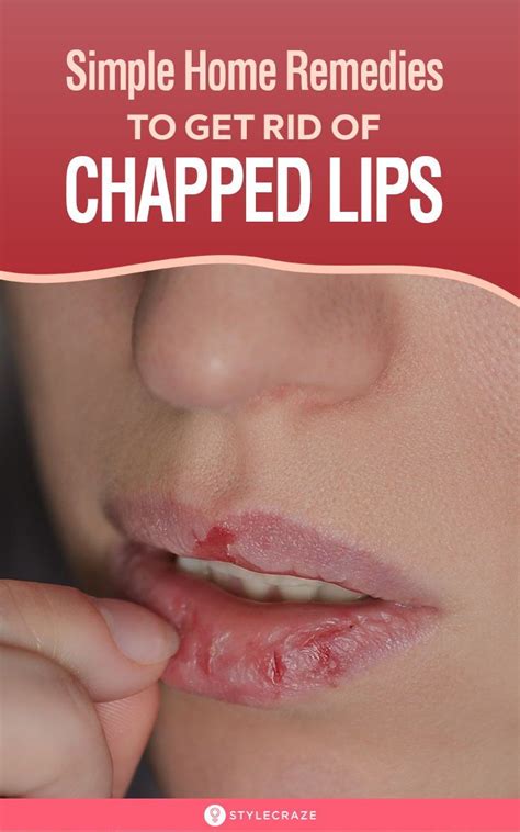 11 Home Remedies To Get Rid Of Chapped Lips Fast | Chapped lips remedy, Chapped lips, Chapped ...