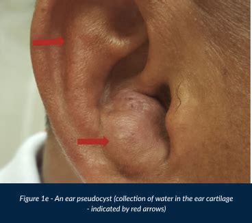 Ear Lumps & Bumps - Dr Gan Eng Cern