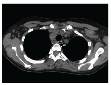 CT scan of chest demonstrated multicompartmental mediastinal... | Download Scientific Diagram