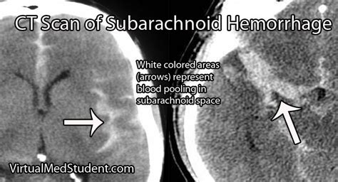 CT Scan of Subarachnoid Hemorrhage Dura Mater, Subarachnoid Hemorrhage ...