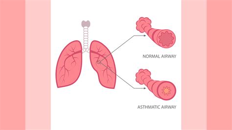 Exploring Homeopathic Approach for Allergic Bronchitis - Doctor Bhatia ...