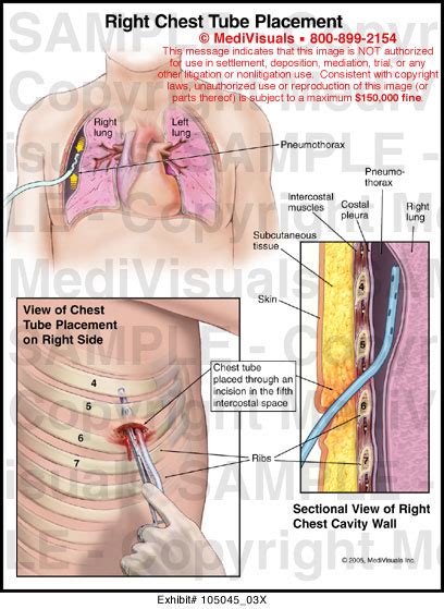 Medivisuals Right Chest Tube Placement Medical Illustration