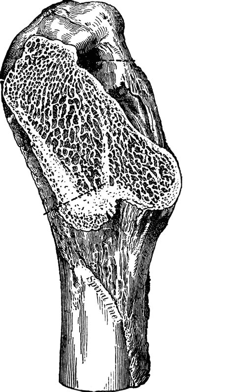 Femoral Spur Of The Femurvintage Illustration Engraving Vintage Line ...