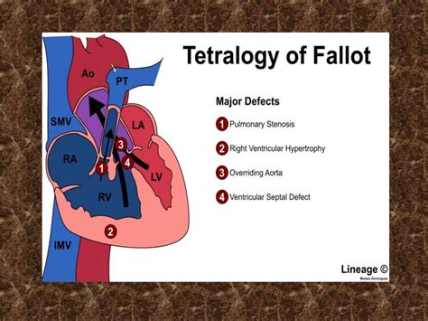 TETRALOGY OF FALLOT AND TET SPELL presentation